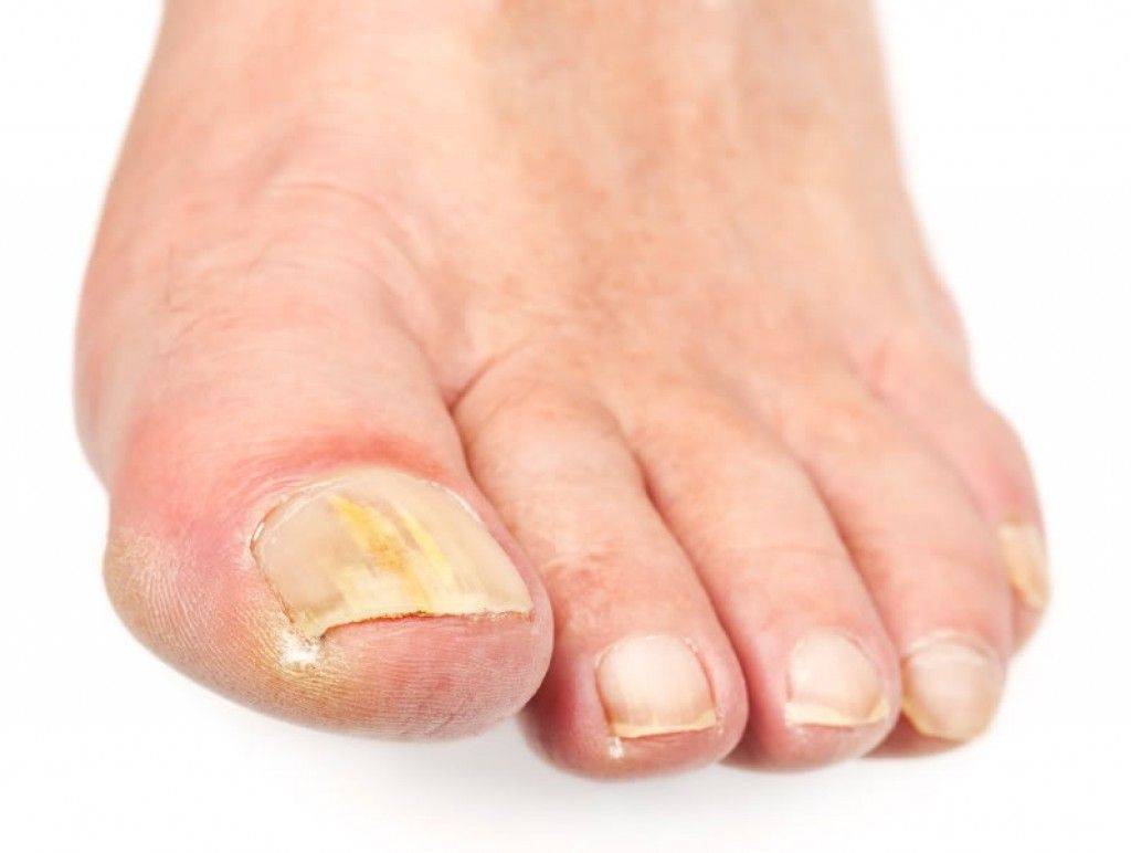 Quanto dura un’infezione fungina delle unghie dei piedi?